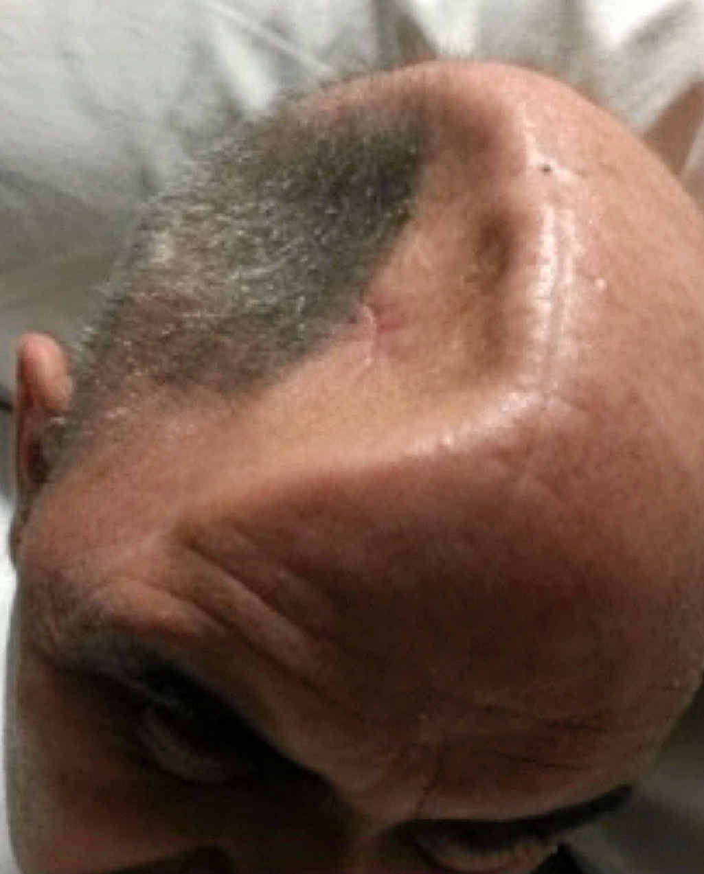 Mr Espley’s skull after the injuries healed and before the new plate was inserted. Mr Espley’s skull after the injuries healed and before the new plate was inserted.
